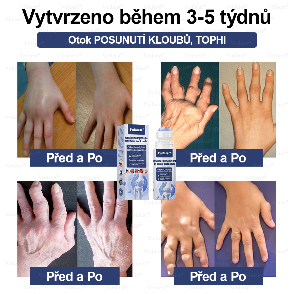 💧Voilaist® Kyselina Salicylová Gel pro úlevu od bolesti kloubů - (snižuje otoky kloubů, bolest, ztuhlost, zarudnutí, teplo, bolestivost a únavu kloubů), obsahuje 4% kyseliny salicylové, glukosamin, MSM, arniku, chondroitin, vitamín K2